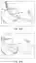 Fig. 35 - DEVICES AND METHODS FOR INCREASING BLOOD PERFUSION TO A DISTAL EXTREMITY