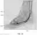Fig. 85 - DEVICES AND METHODS FOR INCREASING BLOOD PERFUSION TO A DISTAL EXTREMITY