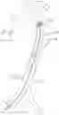 Fig. 01 - Helical balloon catheter