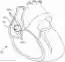 Fig. 01 - CURRENT STEERING TO ACHIEVE SPATIAL SELECTIVITY FOR HIS BUNDLE PACING