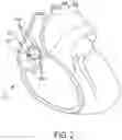 Fig. 03 - CURRENT STEERING TO ACHIEVE SPATIAL SELECTIVITY FOR HIS BUNDLE PACING