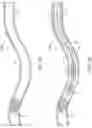 Fig. 02 - Apparatus, system, and method for vasculature obstruction removal