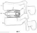 Fig. 02 - Expandable fusion device and method of installation thereof