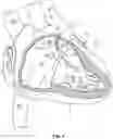Fig. 02 - Tether assemblies for medical device delivery systems