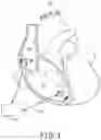 Fig. 02 - Atrial tracking in an intracardiac ventricular pacemaker