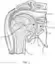 Fig. 02 - Method using a combination reamer/drill bit for shoulder arthroplasty