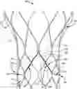 Fig. 01 - Leaflet suturing to commissure points for prosthetic heart valve