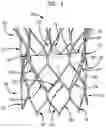 Fig. 02 - Leaflet suturing to commissure points for prosthetic heart valve