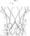 Fig. 03 - Leaflet suturing to commissure points for prosthetic heart valve
