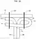 Fig. 11 - Leaflet suturing to commissure points for prosthetic heart valve