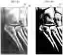 Fig. 04 - System and method for identifying fractures in digitized x-rays