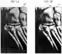 Fig. 05 - System and method for identifying fractures in digitized x-rays