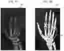 Fig. 10 - System and method for identifying fractures in digitized x-rays