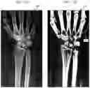 Fig. 13 - System and method for identifying fractures in digitized x-rays