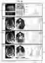Fig. 06 - TERRITORY MAPPING IN PSEUDO-CONTINUOUS ARTERIAL SPIN LABELING