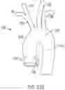 Fig. 22 - SYSTEM FOR USING RADIOFREQUENCY AND LIGHT TO DETERMINE PULSE WAVE VELOCITY