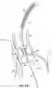 Fig. 08 - Method for delivery of prosthetic aortic valve
