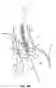 Fig. 09 - Method for delivery of prosthetic aortic valve
