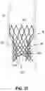 Fig. 49 - Method for delivery of prosthetic aortic valve