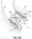 Fig. 64 - Method for delivery of prosthetic aortic valve