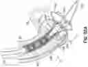 Fig. 65 - Method for delivery of prosthetic aortic valve