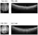 Fig. 22 - OCULAR DELIVERY OF THERAPEUTIC AGENTS