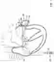 Fig. 02 - Occlusive medical device