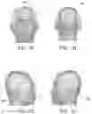 Fig. 02 - Impedance tomography using electrodes of a tumor treating fields (TTFields) system