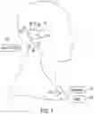 Fig. 02 - Cochlear implant system with electrode impedance diagnostics