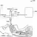 Fig. 01 - CAPTURING TRUNCATED PROTEOFORMS IN EXHALED BREATH FOR DIAGNOSIS AND TREATMENT OF DISEASES