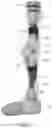 Fig. 02 - ARTIFICIAL KNEE AND PROSTHETIC ASSEMBLY KIT THEREFOR