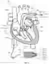 Fig. 09 - MULTI-SENSOR CATHETER FOR RIGHT HEART AND PULMONARY ARTERY CATHETERIZATION