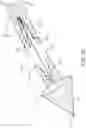 Fig. 12 - WIDE BAND MICROWAVE TISSUE ABLATION PROBE WITH VARIABLE LENGTH ANTENNA PARAMETERS