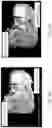 Fig. 14 - SYSTEM, METHOD, AND DEVICE FOR PERFORMING ARTHROGRAPHY