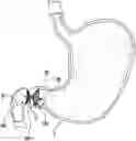Fig. 01 - DEVICES, SYSTEMS, AND METHODS FOR OCCLUDING AN ANATOMICAL PASSAGE