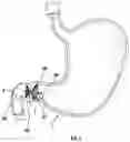 Fig. 02 - DEVICES, SYSTEMS, AND METHODS FOR OCCLUDING AN ANATOMICAL PASSAGE