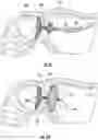 Fig. 07 - DEVICES, SYSTEMS, AND METHODS FOR OCCLUDING AN ANATOMICAL PASSAGE