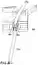 Fig. 10 - Surgical clip for simultaneous bleeding control of a blood vessel and cutting