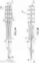 Fig. 06 - Intraosseous sliding osteotomy system and method