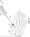 Fig. 22 - Intraosseous sliding osteotomy system and method