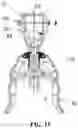 Fig. 09 - Prepuce extruding, cutting, hemostasis, and healing assembly using ultrasonic wave