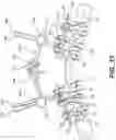 Fig. 24 - PEDICLE SCREW HAVING A REMOVABLE ROD COUPLING