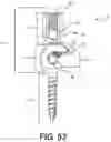 Fig. 43 - PEDICLE SCREW HAVING A REMOVABLE ROD COUPLING