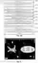Fig. 06 - DEVICES, SYSTEMS AND METHODS FOR ASSISTANCE OF BALLOON ABLATION