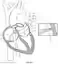 Fig. 12 - Medical device having a support structure