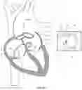 Fig. 13 - Medical device having a support structure