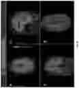 Fig. 07 - SYSTEMS AND METHODS FOR PLANNING AND SIMULATION OF MINIMALLY INVASIVE THERAPY