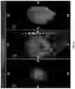 Fig. 09 - SYSTEMS AND METHODS FOR PLANNING AND SIMULATION OF MINIMALLY INVASIVE THERAPY