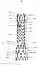 Fig. 06 - SEGMENTED COVERED STENT AND PREPARATION METHOD THEREFOR