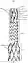 Fig. 07 - SEGMENTED COVERED STENT AND PREPARATION METHOD THEREFOR